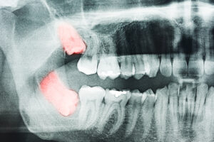 When to Act on Wisdom Teeth Extraction on the Danforth