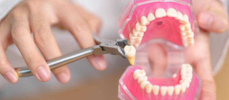 The Gradual Build-Up to Letting a Tooth Go — How Tooth Extraction on the Danforth Becomes the Next Step